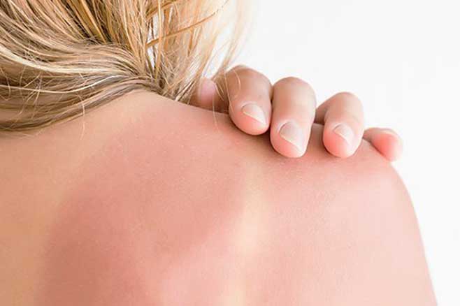 sunburn skin treatment
