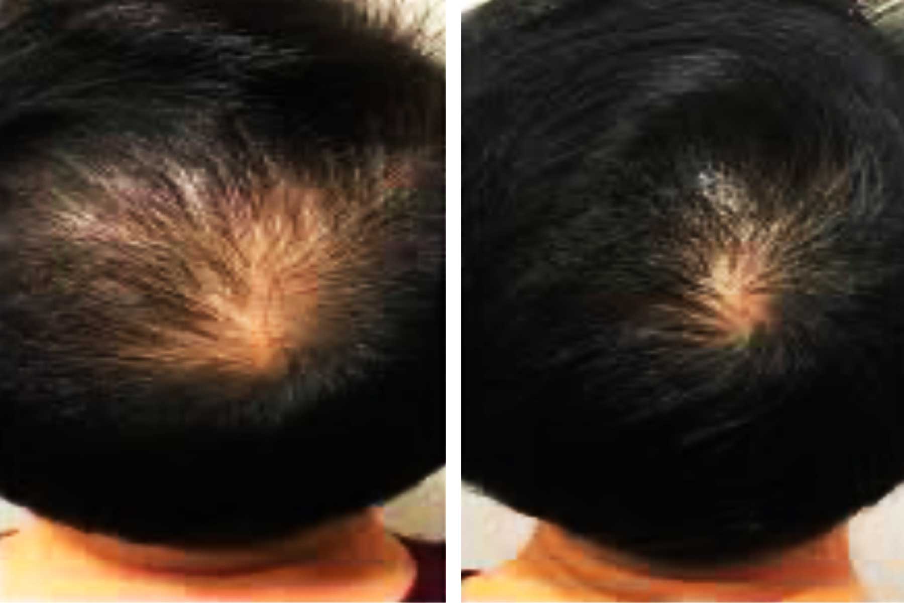Laser Hair Induction