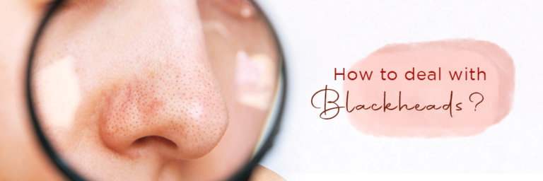 How to deal with Blackheads (1)
