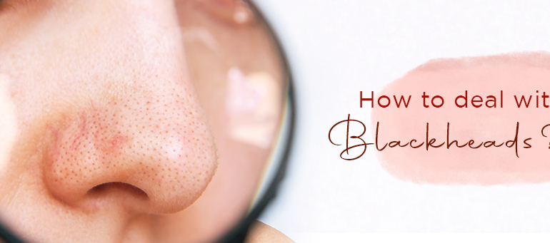 How to deal with Blackheads?