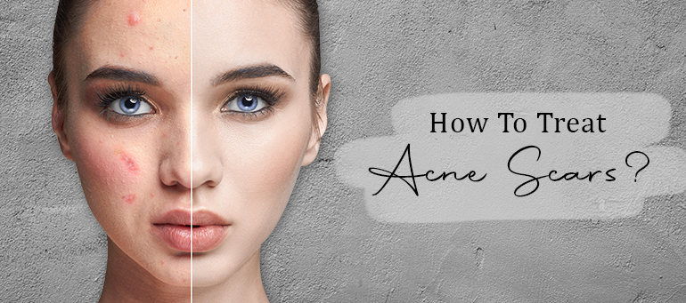 How to treat acne scars?