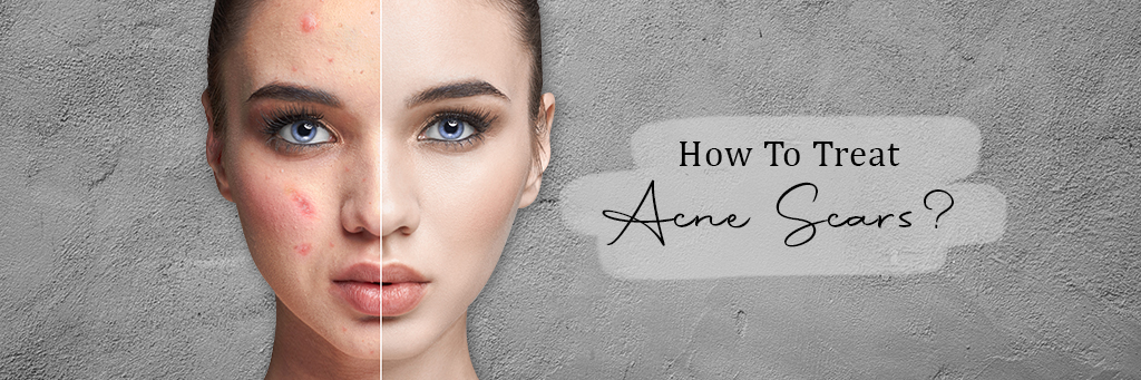 How to treat acne scars?