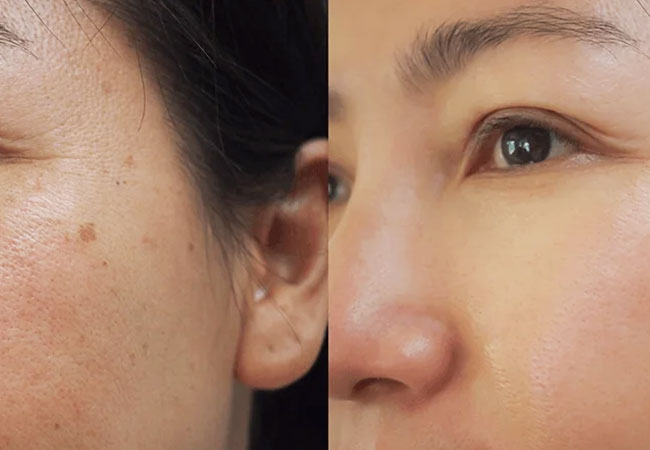 Large pores before & after